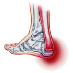 Achilles Tendinopathy – Causes and Treatments